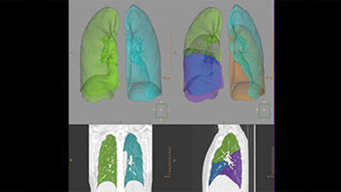 Radiologische scanbeelden van menselijke longen