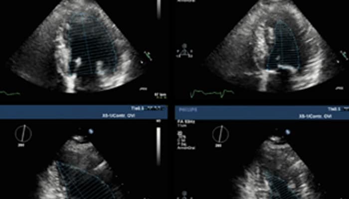 Sténose aortique asymptomatique