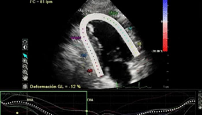 Hypertension et insuffisance cardiaque