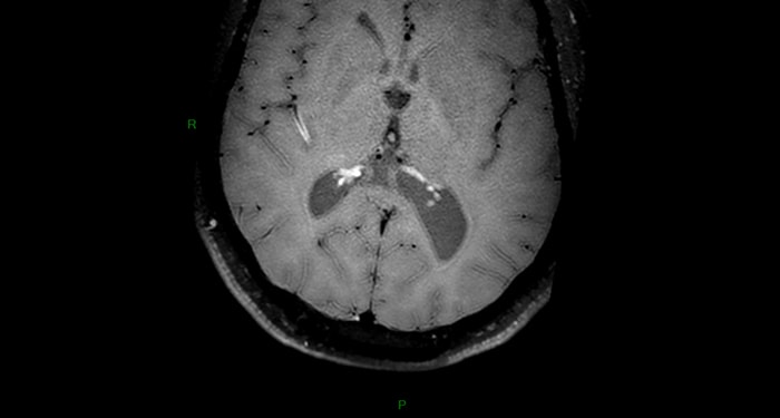 Vasculitis on Black Blood imaging