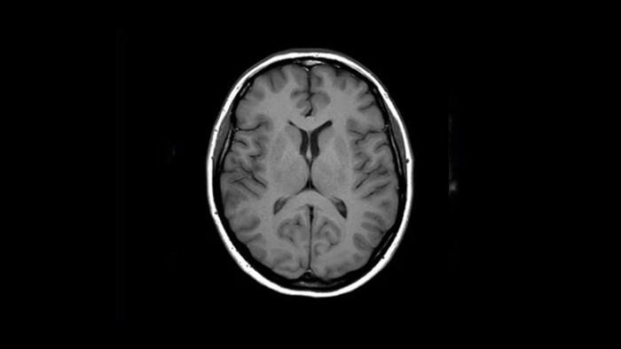 Klinisch beeld van de hersenen