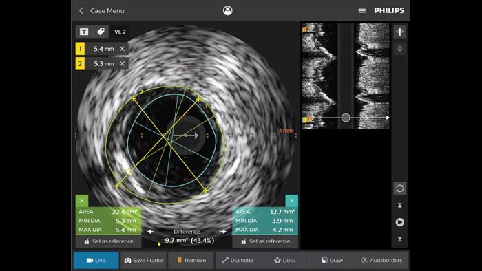 IntraSight fournit plus d'informations grâce aux modalités iFR/FFR et IVUS