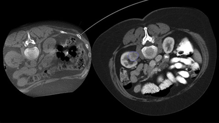 Imagerie des lésions après ablation avec CBCT