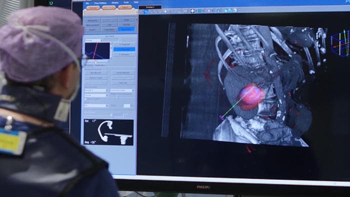 Tumorbiopsie en -ablatie