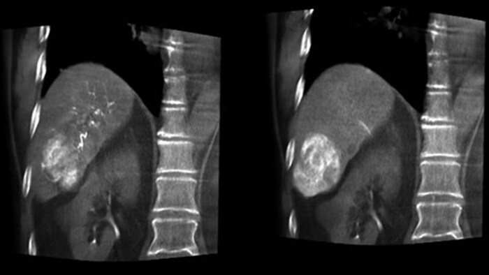 Visualisation optimale des artères et des tumeurs avec CBCT double affichage