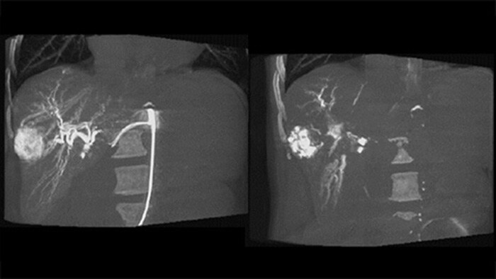 3D-beeldvorming na embolisatie met CBCT