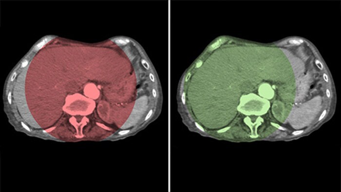 Couverture du foie entier avec CBCT Open