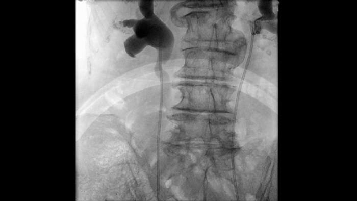 Gepulseerde fluoroscopie