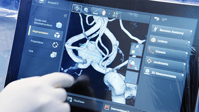 Visualisatie met hoge resolutie op basis van één rotatieangiografierun