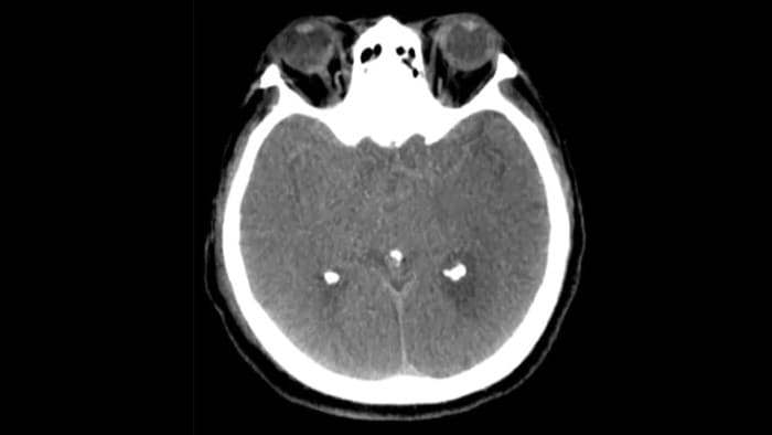 Periprocedurele controle op bloedingen