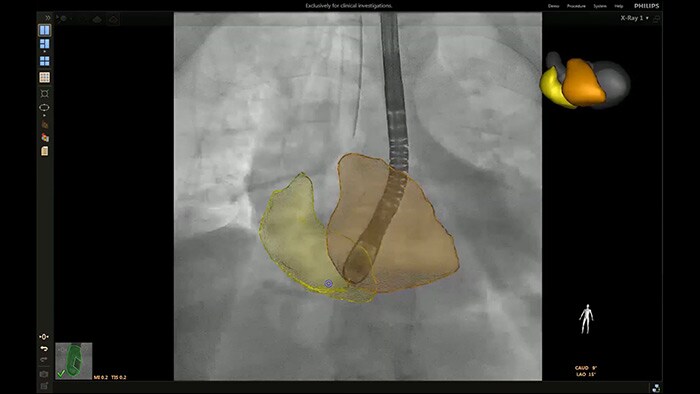 Optimalisatie van de tricuspidalisklepweergave met EchoNavigator hartmodellen