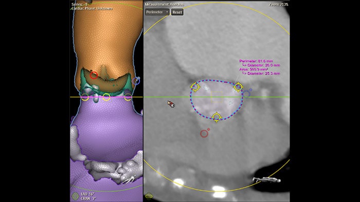 Imagerie clinique Philips HeartNavigator