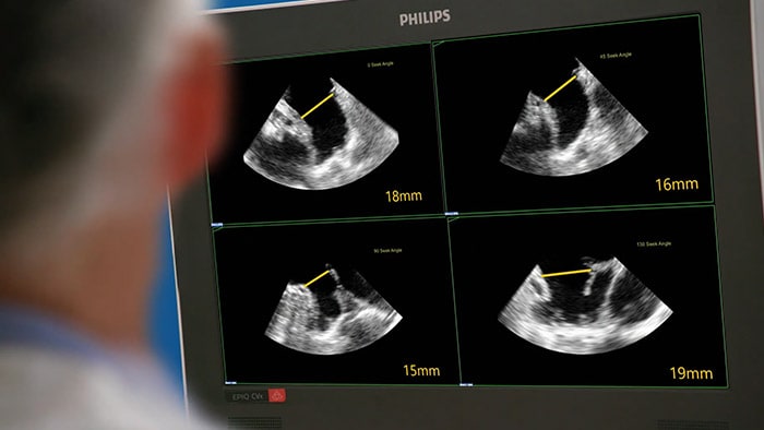 Échographe interventionnel EPIQ CVxi