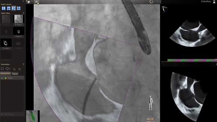 EchoNav modellen aorta mitralis