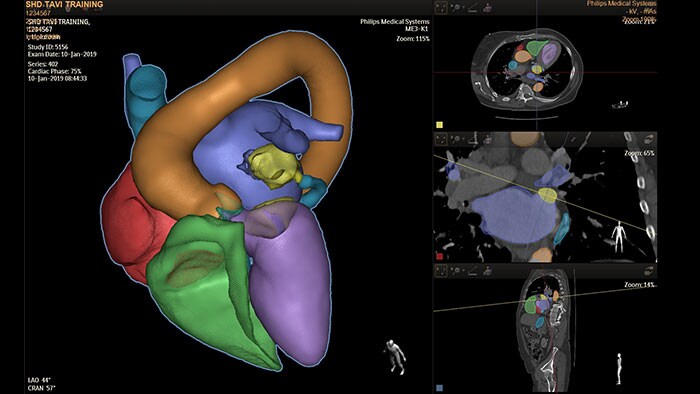 HeartNavigator - Réparation de la valve mitrale