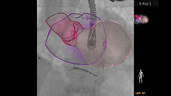 EchoNavigator heroriënteert en combineert echografie en röntgeninformatie