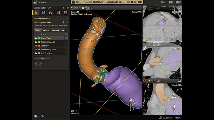 HeartNavigator TAVR and TAVI procedures