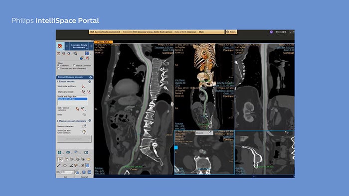 IntelliSpace Portal pour la planification du TAVI