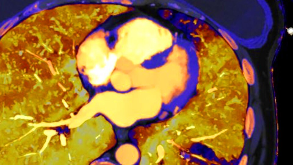 Spectral-detector CT clinical image