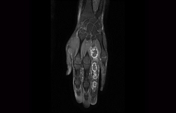 Hand/pols met tumor