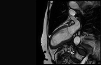 Infarctus aigu du myocarde