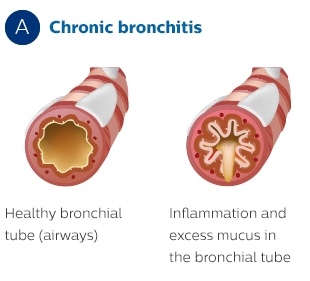 Doorsnede bronchiale buis