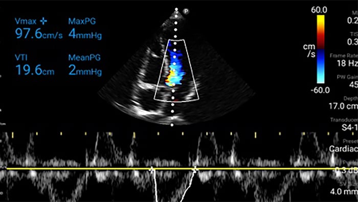 Thumbnail hartdiagram