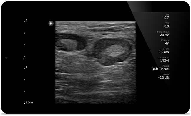 Ervaar dezelfde duidelijkheid als grotere echografiesystemen met Lumify