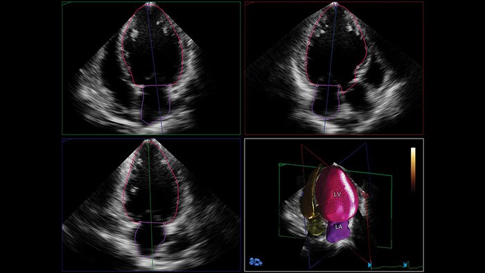 minimale gebruikersinteractie-echografie