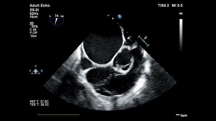 2D- en 3D-transthoracale en transoesofageale transducers