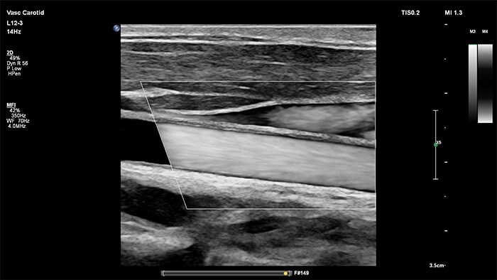 echografie met hoge resolutie