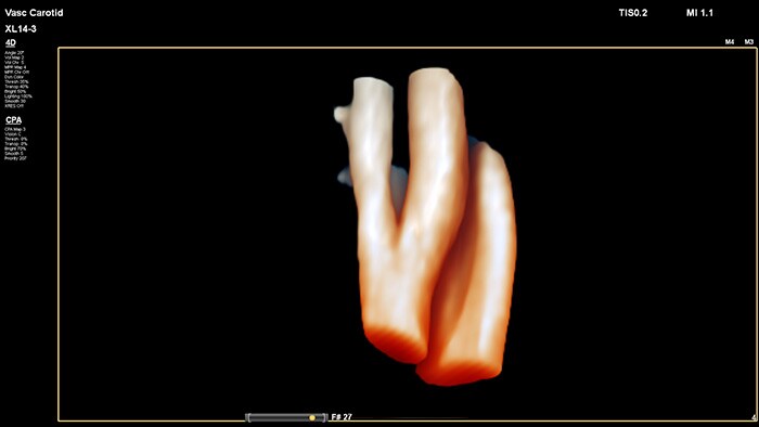 eenvoudige beoordeling van ruimtelijke locatie en samenstelling van plaque, evenals 3D-gegevens over de bloedstroom om stenose of gekronkelde bloedvaten te diagnosticeren