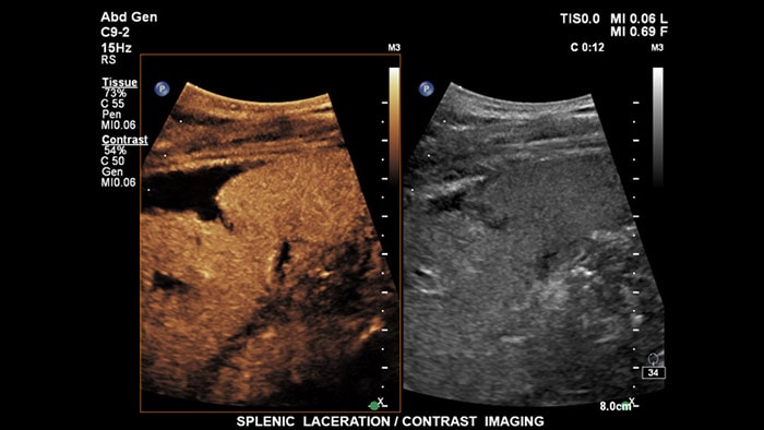 Echografie met contrastverbetering