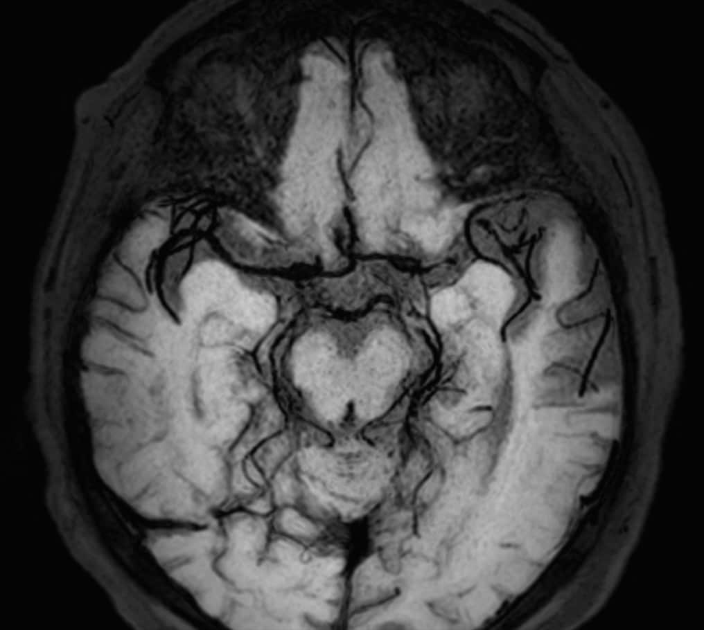 Blackblood MRI