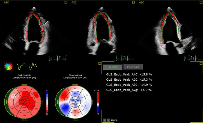 Image showing the AutoStrain LV application