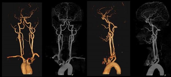 Download image (.jpg) Precise Suite Incisive carotid