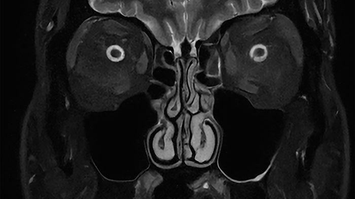 SmartSpeed Precise sinus clinical image -  