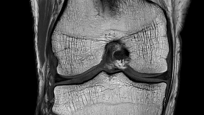 SmartSpeed Precise knee clinical image -  