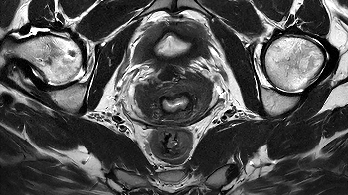 SmartSpeed Precise pelvis clinical image -  